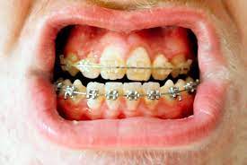 Pin On Oralhealth