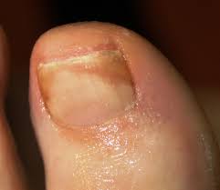 Image result for Pitting nails feet