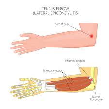 Many aspects of tennis elbow treatment remain controversial among physicians, so treatment recommendations may vary greatly depending on which in this injection procedure, small amounts of the patient's own blood is injected into the affected tendon, which theoretically helps accelerate the. Pros And Cons To Tennis Elbow Surgery Highgate Private Hospital