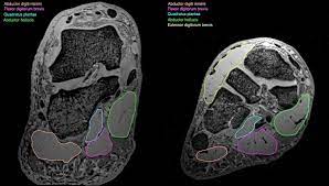 Denervation changes in muscles early. Exploration Of The Deep Foot Muscles At Ultra High Field National Imaging Facility