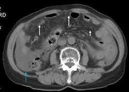 Get a free case evaluation now! Ct Differentiation Of Malignant Peritoneal Mesothelioma And Tuberculous Peritonitis Springerlink