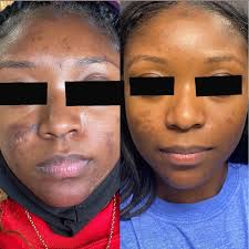 Barbara Winder LE, Wax/ Skin (@estheticianbarb) • Instagram photos and  videos