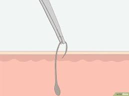 Pin On Ingrown Hair Remedies Bikini