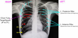 Image result for Chest Tube