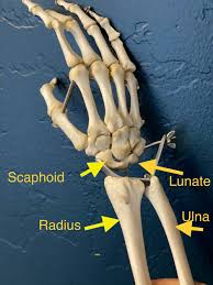 A graphic shows the bones of the hand, carpals, metacarpals and phalanges. Foosh Injury And Why It Can Cause Wrist Pain Scr3