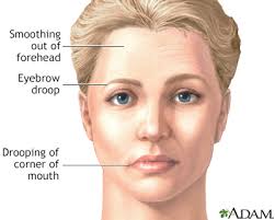 The biggest difference between bell's palsy and a stroke is where the damage occurs. Facial Paralysis Information Mount Sinai New York