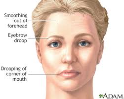 However, in rare cases, it can affect both sides. Bell Palsy Information Mount Sinai New York