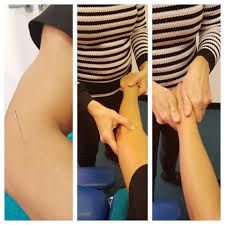 Tennis elbow — painful condition is caused by repetitive motions of the wrist and arm. Forarm And Elbow Nerve Pain Down Arm Or Hand Perth Chiropractor Joondalup Perth Chiropractor Lakeside Chiropractic