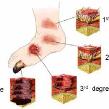Degrees Of Burn Relative Depths Of 1 St 2 Nd 3 Rd And 4 Th Degree Download Scientific Diagram