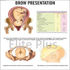 Image result for Brow Presentation