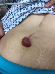Image result for Nodule