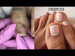 Simple diseño de uñas decoradas para pies con detalle de flor azul en sus uñas del dedo gordo. Increible Transformacion Diseno De Unas Para Pies Best Foot Pedicure Transformation Youtube Disenos De Unas Unas Algodon De Azucar Disenos De Unas