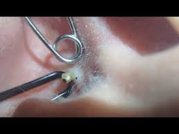 Removing Pimple Inside The Ear Bizarre 2016 Pimple Popping Pimples Wart Treatment