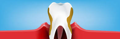 In the early stages, periodontitis has very few symptoms, and in many individuals the disease has progressed significantly before they seek treatment. What Is Periodontitis Treatments Signs And Symptoms Oral B