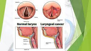 This type of cancer can damage your. Laryngeal Cancer Youtube