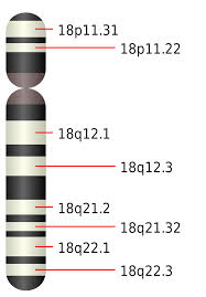 edwards syndrome wikipedia