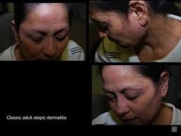 6. dermatitis and its variants