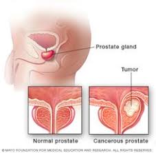 Prostate cancer is the most common cancer among men. 8 Prostate Massages Ideas Prostate Prostate Massage Prostate Health