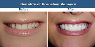 Anything new and trendy you are doing with them? Porcelain Veneers Glendale Smile Makeover Of La
