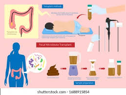 Image result for Fecal Transfer