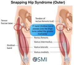 Image result for Snapping Hip