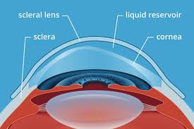 Scleral Lenses Have Many Uses Including In The Movies Eye Care Dry Eyes Causes Eyes Problems