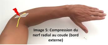 Épicondylite (douleur du coude) : Compression Du Nerf Radial Au Coude Traitement Definition Docteurclic Com