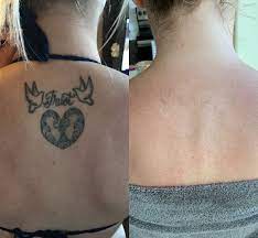 My Tattoo Removal Experience Beauty And The Blonde Tattoo Removal Cream Tattoo Removal Laser Tattoo Removal