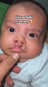 Perbaikan Bibir Sumbing Bilateral: Pengukuran Desain yang Akurat