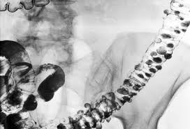 Diverticulitis treatment can range from antibiotics to surgery for complicated diverticulitis. Diverticular Disease And Diverticulitis Causes Symptoms And Treatment Learning Article Pharmaceutical Journal