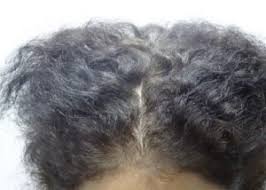 Screening to establish these levels in cases of hair loss and supplementing with them when they are deficient may be beneficial in the treatment of disease. Low Ferritin Hair Loss Story With Absolique Trichologist