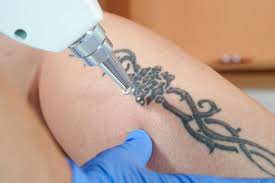 After receiving a laser removal treatment, our patients can expect to see some blisters, crusts, or scabs beginning to develop between 8 and 72 hours after the treatment. Procedure Laser Tattoo Removal