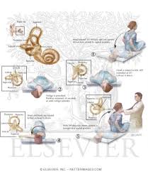 Image result for Canalith Repositioning Procedure