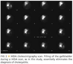 Image result for HIDA Scan