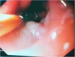 Celiac Disease In Association With Gilbert S Syndrome Springerlink