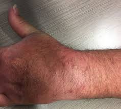 Image result for Scaphoid Fracture Signs