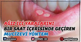Mucizevi Yontem Iste Aft Yaralarini 1 Saat Icerisinde Geciren Yontem Agiz Icinde Olusan Aftlar Icin Gargara Yapabileceginiz Bir Dogal Dogal Tedaviler Saglik