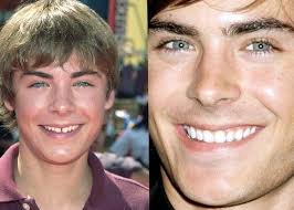 9 Celebrity Smiles Before & After ideas to save today