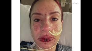 Fundraiser for Ada Marie Plaza Nieves by Robinson Camacho : Ada batallando  el Steven Johnson's Syndrome