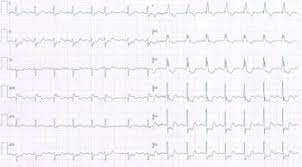 Acute Myocardial Infarction Mi Cardiovascular Disorders Merck Manuals Professional Edition