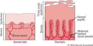 Generally, every 30 days, the skin is renewed with new cells that are placed first in the lower part and then, when they reach originally answered: Psoriasis More Than Skin Deep Harvard Health