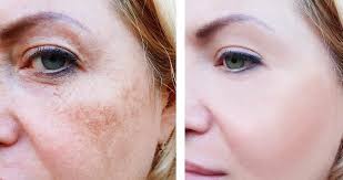 Dark spot corrector ✔ advance clinical treatment skin whitening solution for your dark spots. Best Drugstore Dark Spot Corrector Reviews 2019 That Works