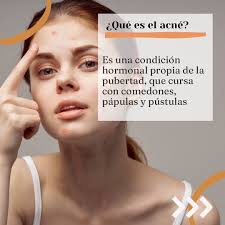 El acné es una condición común de la piel que afecta a muchas personas.  Conoce los diferentes tipos de acné para entender mejor tu situación  👨🏻‍⚕️🩺