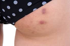 Put a washcloth in hot water—but not so hot that it would burn your skin, says dr. What Causes Butt Pimples How To Get Rid Of Butt Acne Fast Allure