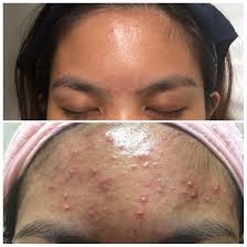 Learn more about the improvements to expect before and after retinol. Acne 1 Year After Tretinoin Update Clearer Skin Skin Clear Skin Fast