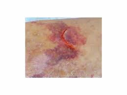 Image result for Skin Tear