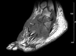 Charcot arthropathy, also known as charcot neuroarthropathy or charcot foot and ankle, is a syndrome in patients who have peripheral neuropathy, or loss of sensation, in the foot and ankle. Charcot Joint Radiology Reference Article Radiopaedia Org