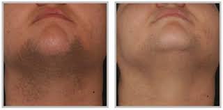We did not find results for: Laser Hair Removal Don T Let Unwanted Hair Embarrass You Anymore With Laser Hair Removal Luminique Cosmetic Laser Centre