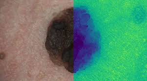 Blood tests to detect cancer. Detecting Skin Cancer Using Hyperspectral Images Advanced Science News