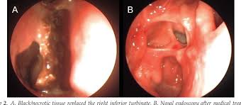 La importancia de un abordaje multidisciplinar agresivo. Orbital Exenteration A Dilemma In Mucormycosis Presented With Orbital Apex Syndrome Semantic Scholar